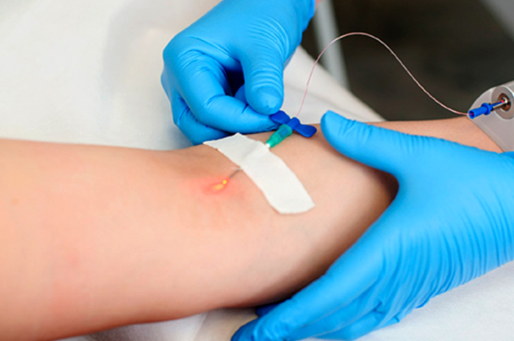 ВЛОК - внутривенное лазерное облучение крови